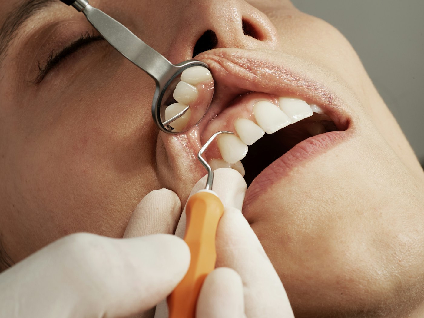 Close-up of a dental examination using a mirror, illustrative stock photograph